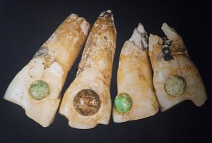 Teeth Embedded With Jade and Stones